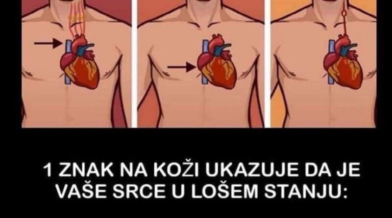 1 ZNAK NA KOŽI UKAZUJE DA JE VAŠE SRCE U LOŠEM STANJU: Obratite pažnju, ako ovo primijetite javite se doktoru