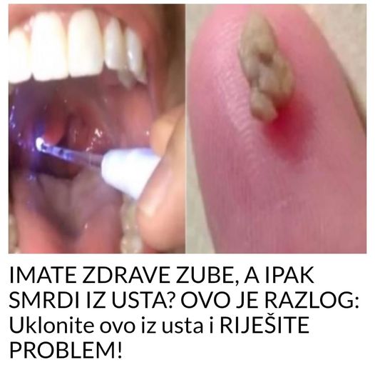 IMATE ZDRAVE ZUBE, A IPAK SMRDI IZ USTA? OVO JE RAZLOG: Uklonite ovo iz usta i RIJEŠITE PROBLEM!