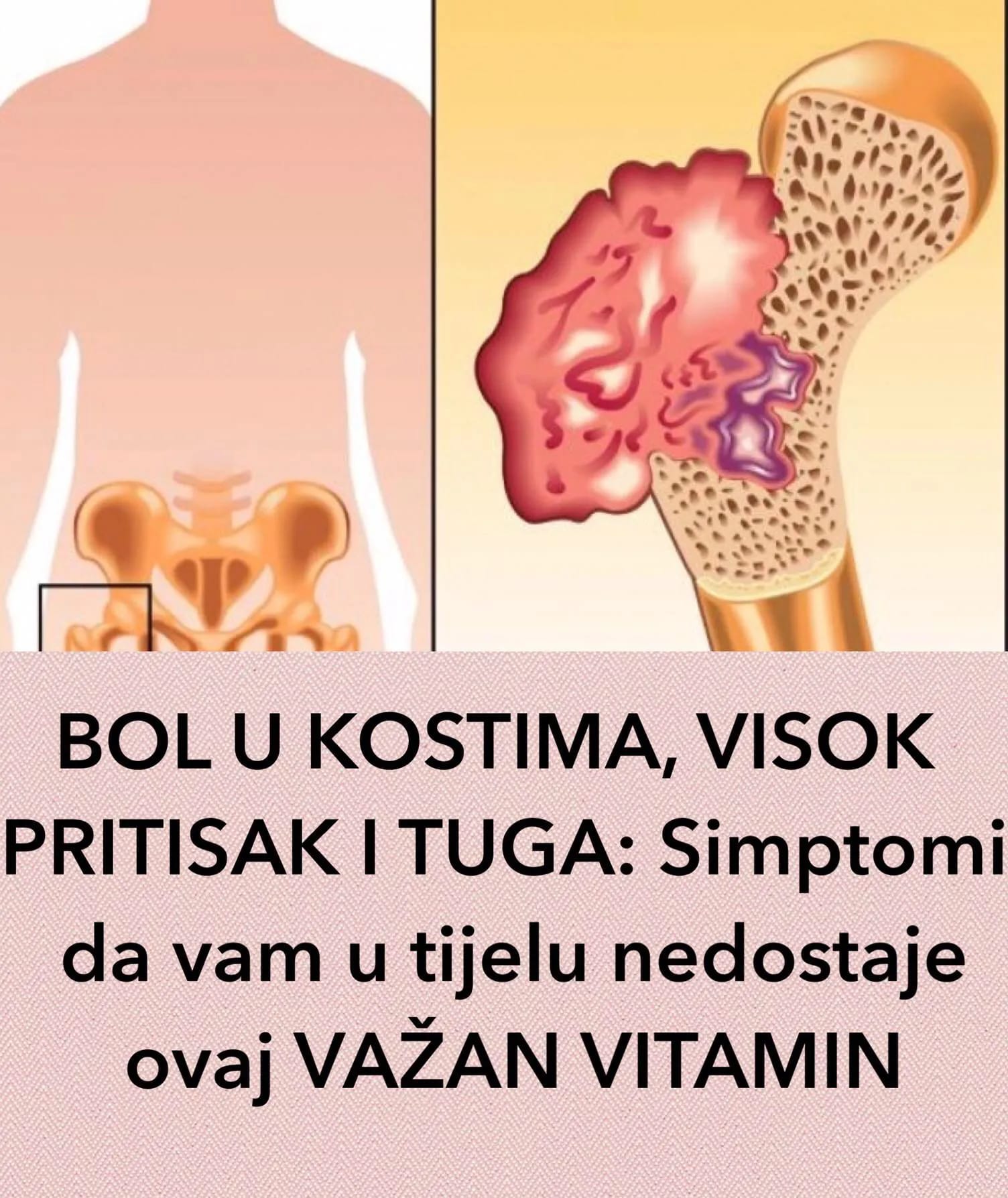 B0L U KOSTIMA, VIS0K PRITISAK I TUGA: Simptomi da vam u tijelu nedostaje ovaj VAŽAN VITAMIN