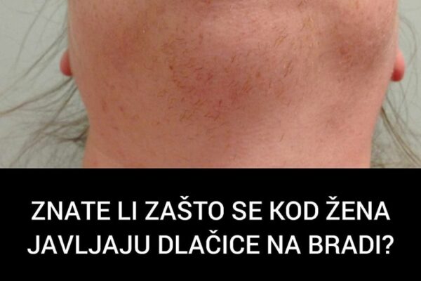 ZNATE LI ZAŠTO SE KOD ŽENA JAVLJAJU DLAČICE NA BRADI? Ovako vas organizam upozorava