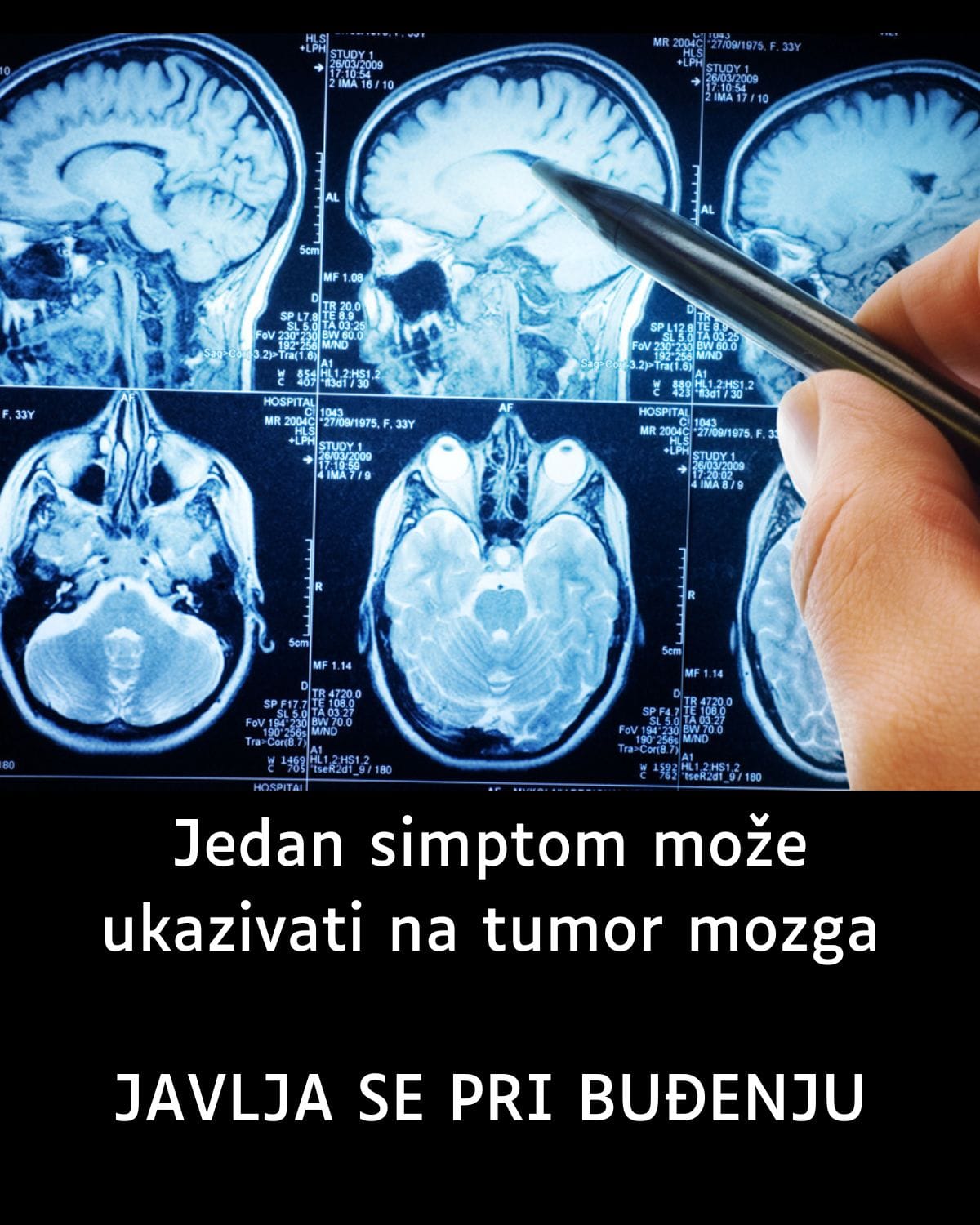 Jedan simptom može ukazivati na tumor mozga: JAVLJA SE PRI BUĐENJU