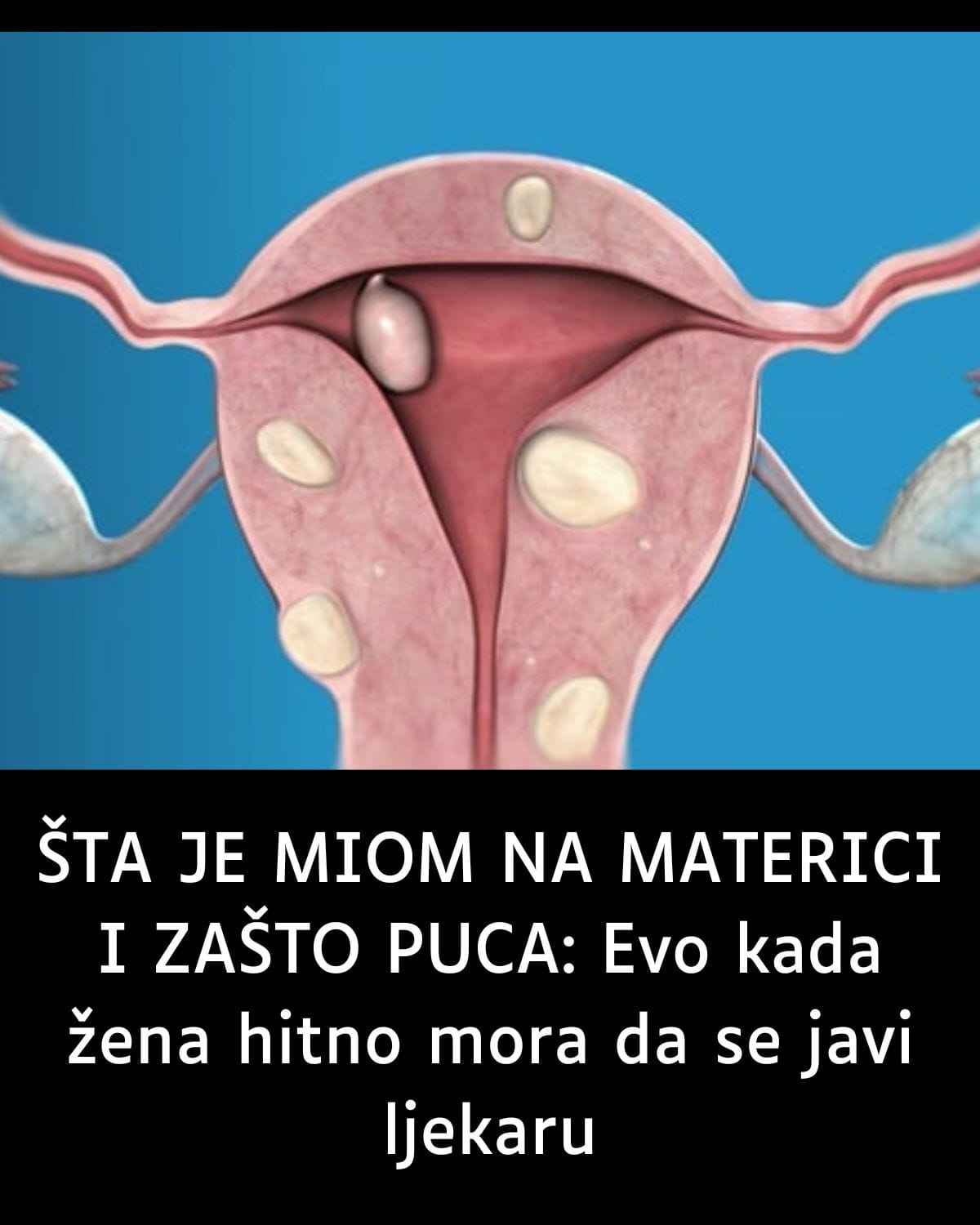 ŠTA JE MIOM NA MATERICI I ZAŠTO PUCA: Evo kad žena hitno mora da se javi ljekaru