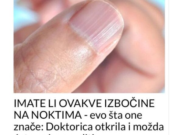 IMATE LI OVAKVE IZBOČINE NA NOKTIMA – Evo Šta One Znače: Doktorica Otkrila I Možda Ćete Se Iznenaditi